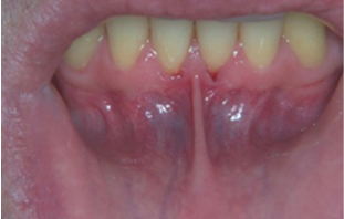Before: Thin gum, gum recession and frenum pull