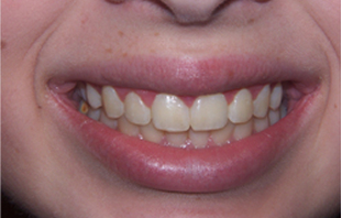 After: Cosmetic gum lifting / Crown Lengthening