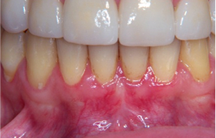 After: Gum graft tunneling technique and frenectomy