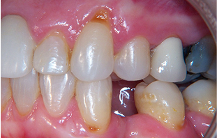 Before: Gum recession and root cavity