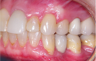 After: Gum graft with tunneling technique