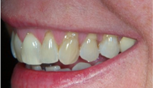 Before: Gum recession with old discolored composite filling on the root