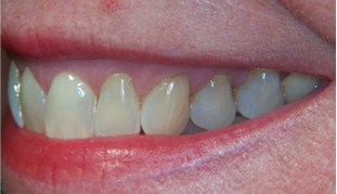 After: Gum graft with tunneling technique; old composite filling on root removed