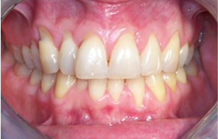 Before: Severe gum recession, root damage and uneven gum line