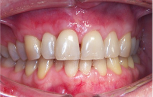 After: Gum grafting with tunneling technique