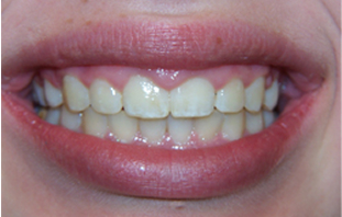 Before: Gummy smile and short teeth